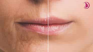 Lips rejuvenation and volume restoration with fillers and laser