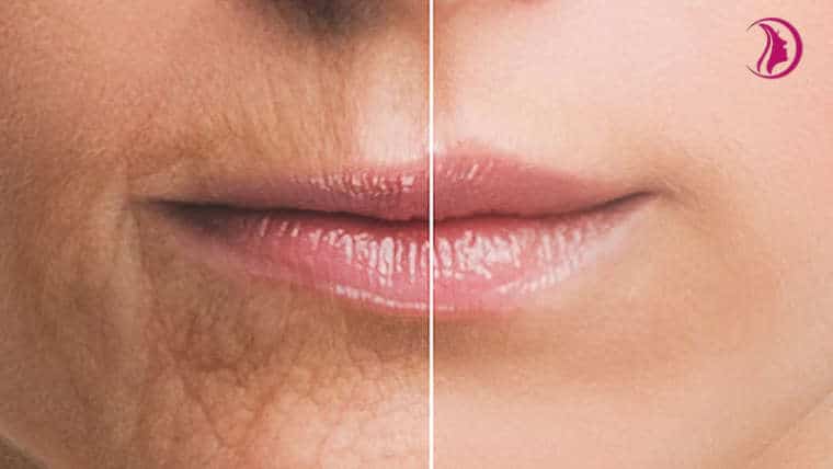 Lips rejuvenation and volume restoration with fillers and laser