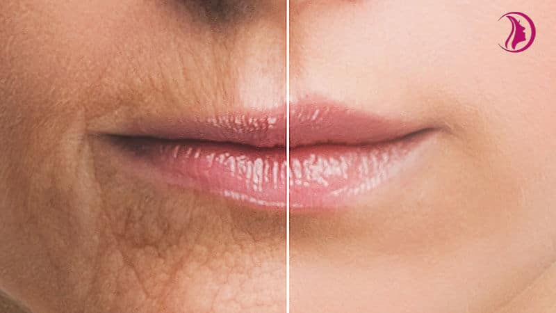 Lips rejuvenation and volume restoration with fillers and laser -  CosmoBeats Center