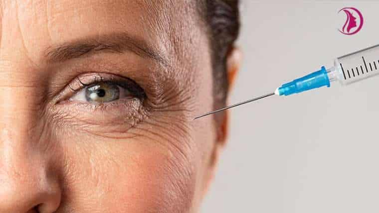 Treating Crow’s Feet with Botox